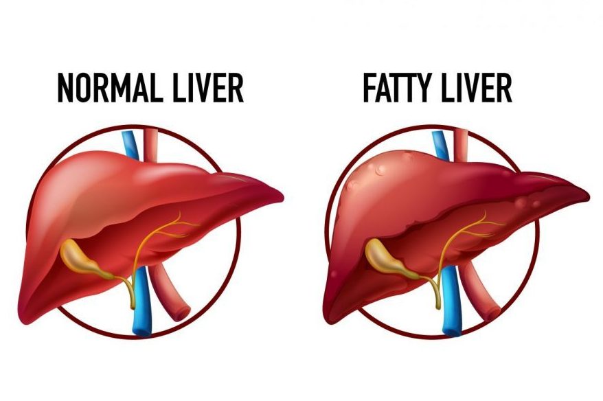 Fatty Liver: One More Silent Killer