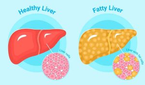 A Quick & Helpful Guide on Fatty Liver & Fibroscans