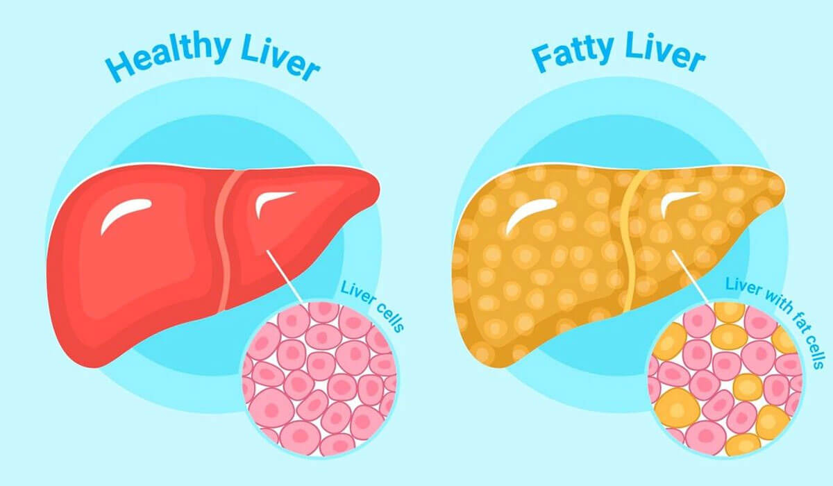 A Quick & Helpful Guide on Fatty Liver & Fibroscans